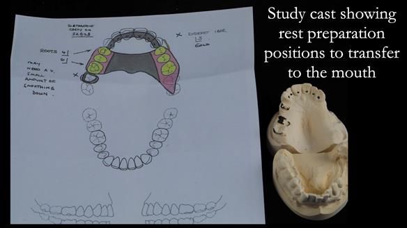 Finlay's Newsletter 60 Sylvia's upper Kennedy Class 2 Mod 1 metal based upper RPD