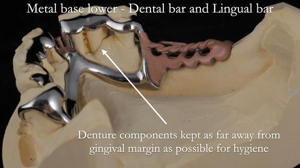 Newsletter 54 case presentation upper complete denture and lower Scandinavian designed hygienic partial denture for David