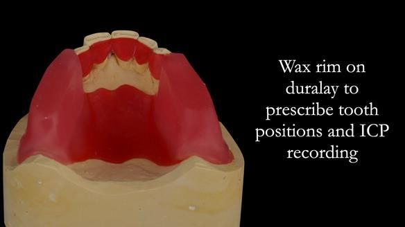 Finlay's Case Study Newsletter 40 - Immediate Mk 1 RPD to Definitive Mk 2 RPD - full protocol