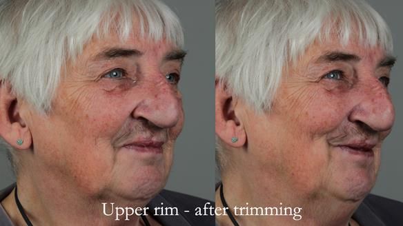 Newsletter 55 Provision of metal based partial dentures for Zephyrine with a repaired cleft lip and palate