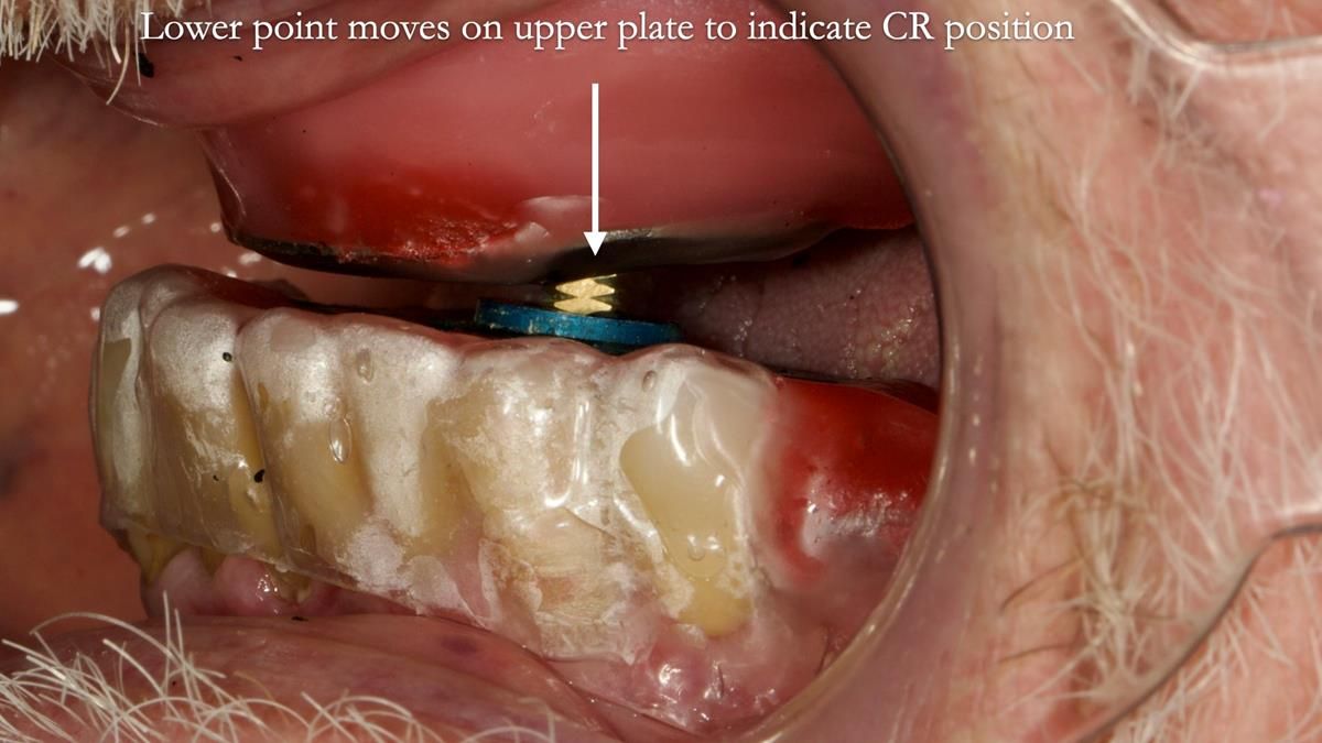 Newsletter 87 – Father Peter: A Partial Denture that needed Minor Miracle