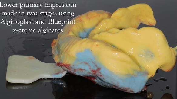 Finlay's Newsletter 62 provision of extractions and metal based complete dentures for Rafique