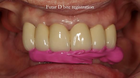 Newsletter 76: Jackie’s case – Telescopic overdenture & precision RPD (the tricky truth!)
