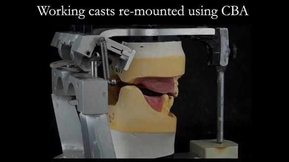 Finlay's Case Study Newsletter 40 - Immediate Mk 1 RPD to Definitive Mk 2 RPD - full protocol