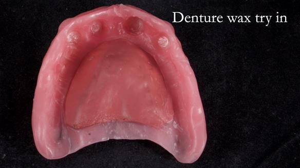 Newsletter 65 Marisa Provision of Complete Dentures on badly placed implants