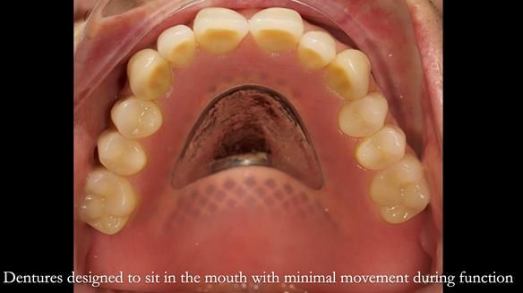 Newsletter 54 case presentation upper complete denture and lower Scandinavian designed hygienic partial denture for David