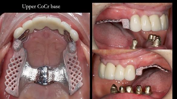 Newsletter 76: Jackie’s case – Telescopic overdenture & precision RPD (the tricky truth!)