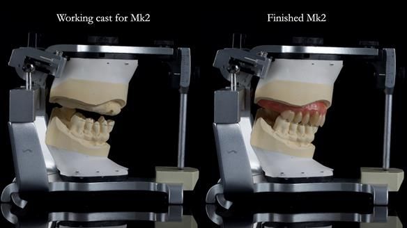 Newsletter 77: Jeremy’s case – immediate complete upper denture