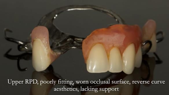 Eileen's transformation with upper and lower RPDs of Scandinavian hygienic design FULL PROTOCOL