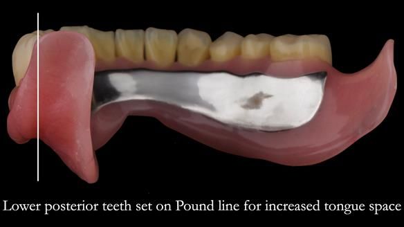 Complete denture Class II div 2 deep overbite Newsletter 39