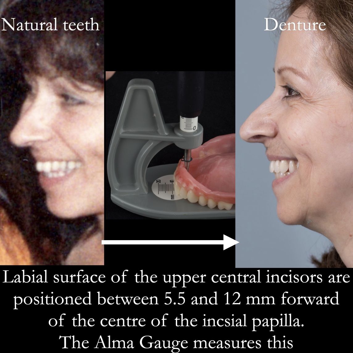Positioning artificial teeth relative to the edentulous ridge