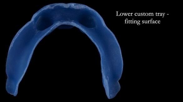 Newsletter 57 showcases the making and fitting process of implant-supported complete dentures for Alisdair