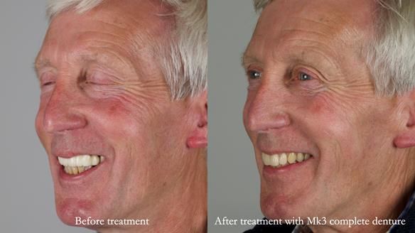 Newsletter 77: Jeremy’s case – immediate complete upper denture