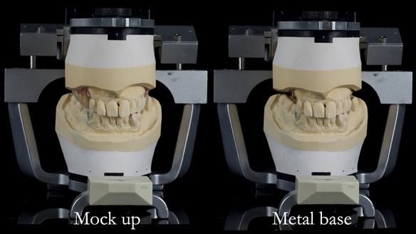 Newsletter 56 showing the making and fitting of a bilateral free end saddle upper removable partial denture (RPD) for patient with pemphigus