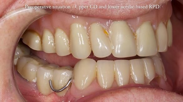 Newsletter 82 Mary - A complete upper and a one-tooth gasket denture