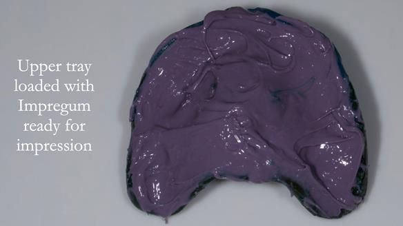 Newsletter 57 showcases the making and fitting process of implant-supported complete dentures for Alisdair