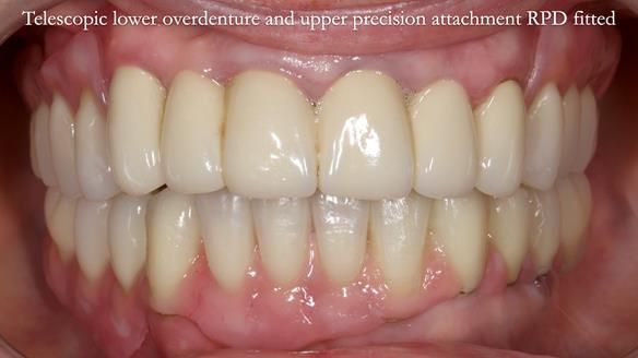 Newsletter 76: Jackie’s case – Telescopic overdenture & precision RPD (the tricky truth!)