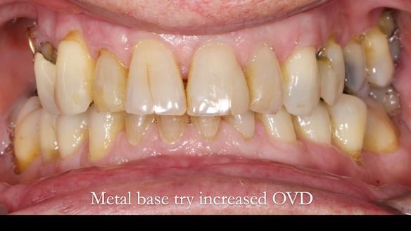 Finlay's Newsletter 64 case study - provision of a Kennedy class 2 metal based Scandinavian RPD for Ian