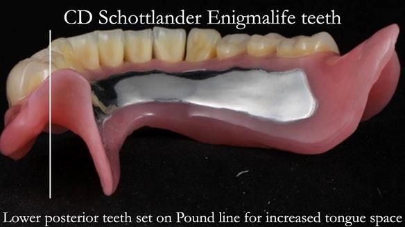 Finlay's Newsletter 62 provision of extractions and metal based complete dentures for Rafique