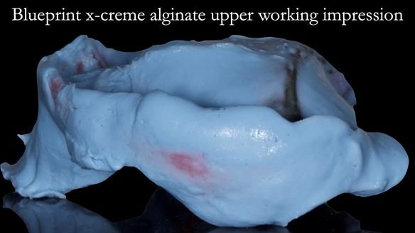 Newsletter 52 Managing Jo’s failing dentition with extractions and Mk 1/Mk 2 complete upper dentures and lower partial dentures FULL PROTOCOL