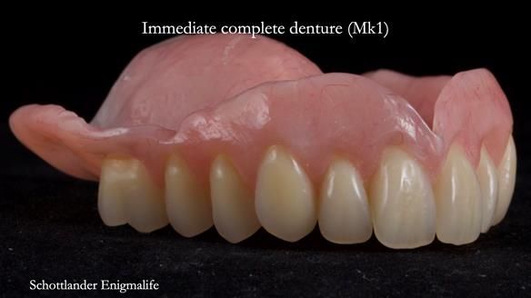Newsletter 77: Jeremy’s case – immediate complete upper denture