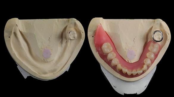 Finlay's Newsletter 59 Ultra hard partial dentures made for Gill