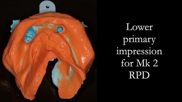 Finlay's Case Study Newsletter 40 - Immediate Mk 1 RPD to Definitive Mk 2 RPD - full protocol