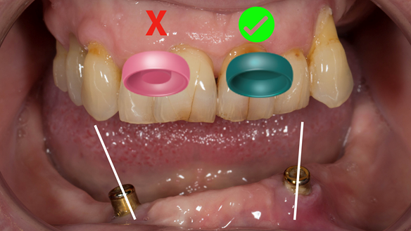 Figure 7 Green locator attachments (without male insert) work better on divergent dental implants