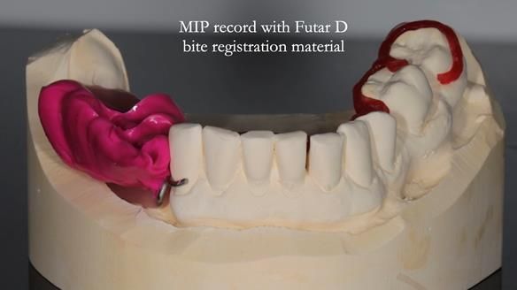 Finlay's Newsletter 61 provision of a lower unilateral free end saddle metal based partial denture for Joyce