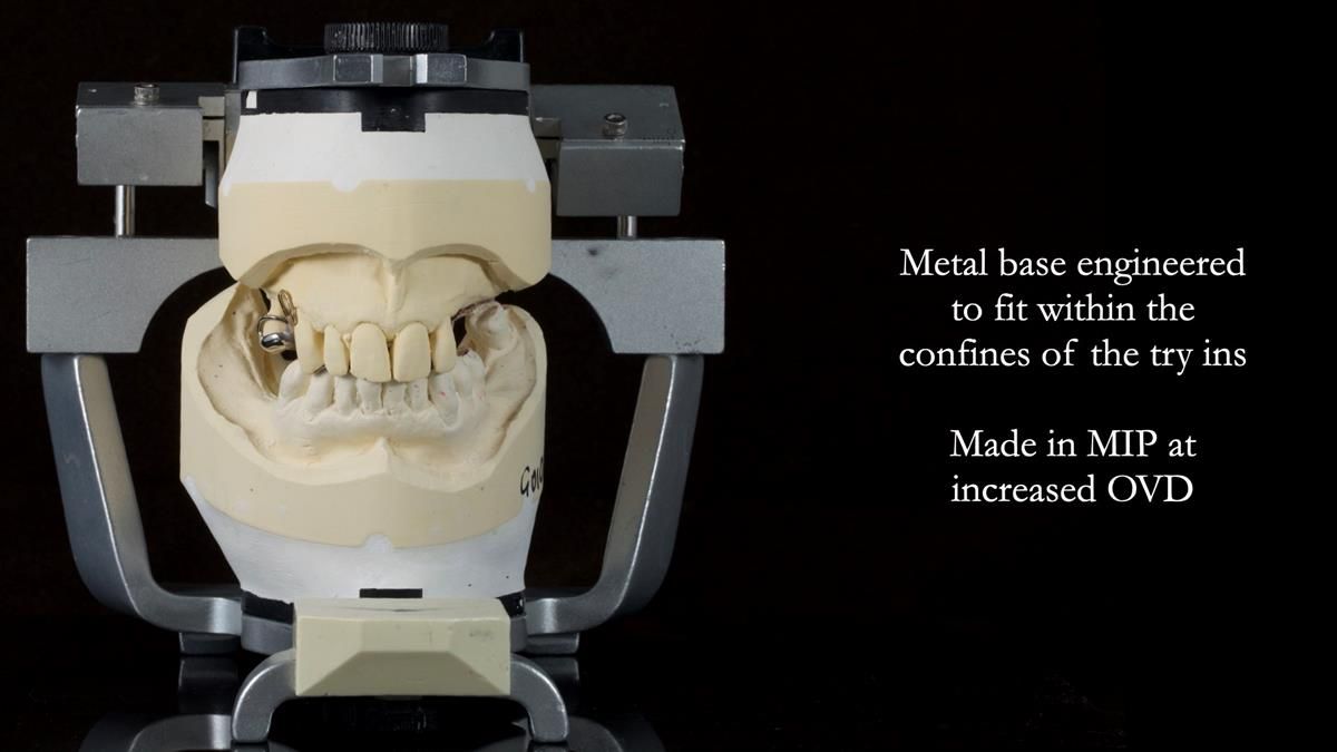 Newsletter 89 – Simon: A Challenging Kennedy Class II Division 1 Upper CoCr Partial Denture with a High Smile Line