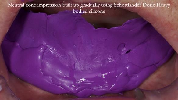 Newsletter 83: Sheila’s Complete Denture Success