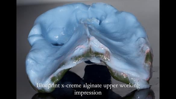 Newsletter 55 Provision of metal based partial dentures for Zephyrine with a repaired cleft lip and palate