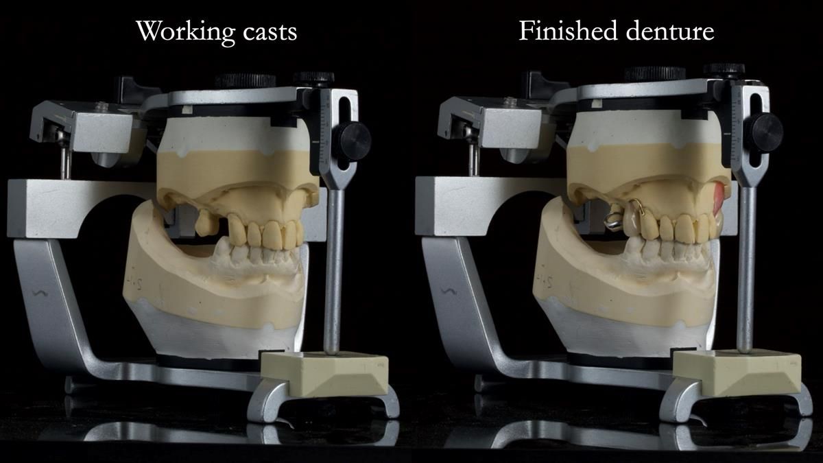 Newsletter 89 – Simon: A Challenging Kennedy Class II Division 1 Upper CoCr Partial Denture with a High Smile Line