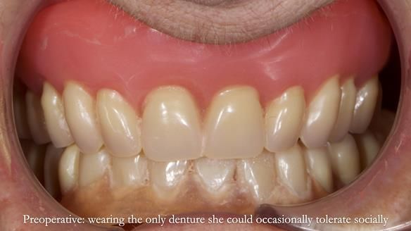 Newsletter 83: Sheila’s Complete Denture Success