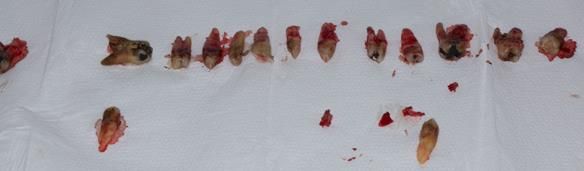 Figure 39 Visit two removal of all upper natural teeth, LR5 and LL4
