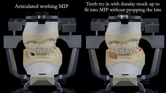Finlay's Newsletter 61 provision of a lower unilateral free end saddle metal based partial denture for Joyce