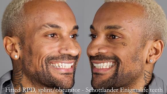 Upper metal base partial denture/occlusal stabilisation splint/obturator - full protocol