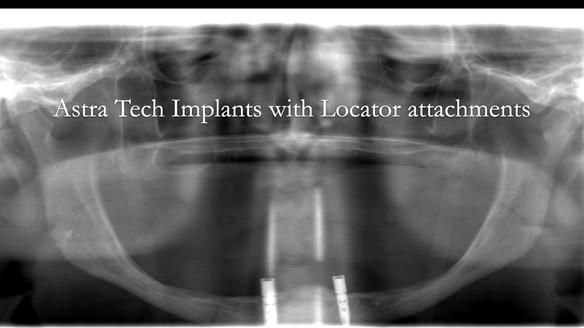 Managing poor implant positioning with complete dentures and Locator attachments - full protocol Newsletter 41