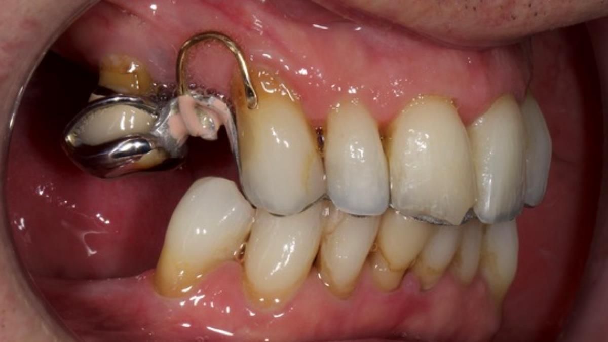 Newsletter 89 – Simon: A Challenging Kennedy Class II Division 1 Upper CoCr Partial Denture with a High Smile Line