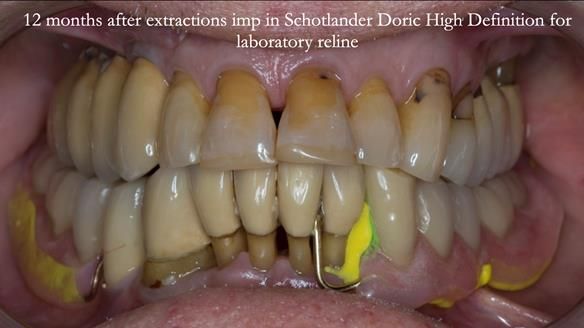 Ken – going downhill, first class