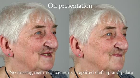 Newsletter 55 Provision of metal based partial dentures for Zephyrine with a repaired cleft lip and palate