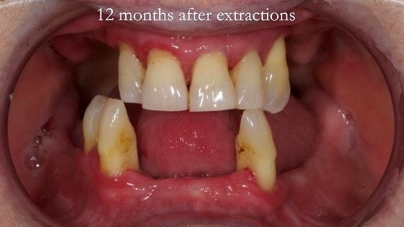Finlay's Case Study Newsletter 40 - Immediate Mk 1 RPD to Definitive Mk 2 RPD - full protocol