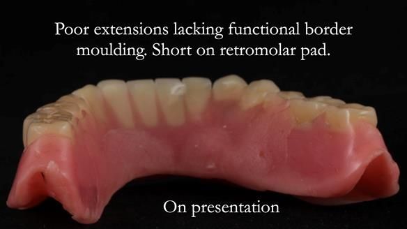 Finlay's Newsletter 62 provision of extractions and metal based complete dentures for Rafique