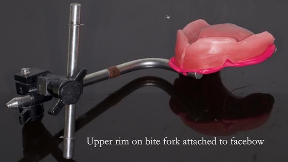 Newsletter 82 Mary - A complete upper and a one-tooth gasket denture