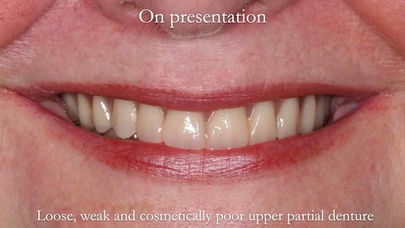 Finlay's Newsletter 58 Gasket upper partial denture for Zoe