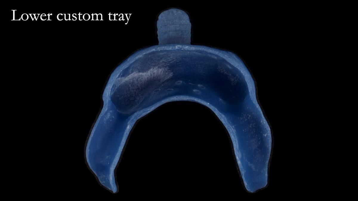 Newsletter 87 – Father Peter: A Partial Denture that needed Minor Miracle