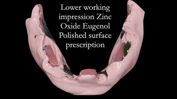 Complete denture Class II div 2 deep overbite Newsletter 39