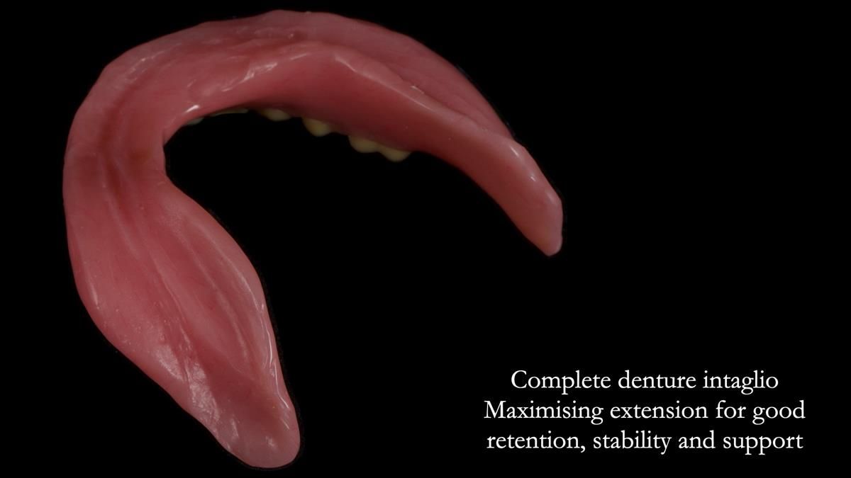 Fin’s Newsletter 88 — Complete dentures - full protocol… he rearranged his own teeth!