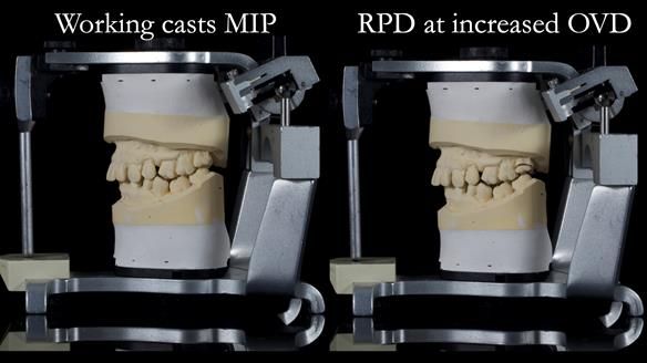 Finlay's Newsletter 64 case study - provision of a Kennedy class 2 metal based Scandinavian RPD for Ian