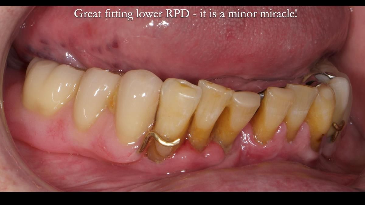 Newsletter 87 – Father Peter: A Partial Denture that needed Minor Miracle